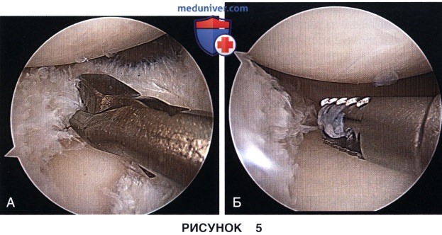 Доступ и техника артроскопического лечения дискоидного мениска коленного сустава