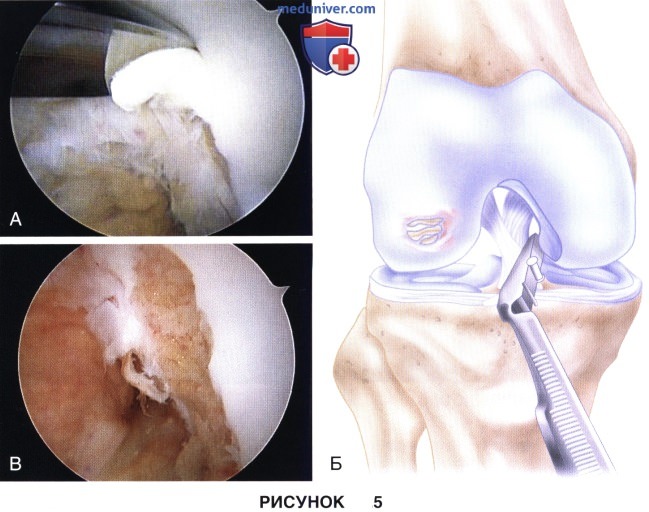 Доступ, техника имплантации аутологичных хондроцитов в коленный сустав