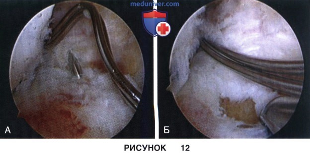 Доступ, техника операции при повреждении передней крестообразной связки (ПКС) у детей