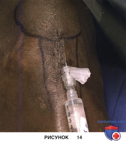 Доступ, техника операции по поводу тендинопатии сухожилия надколенника