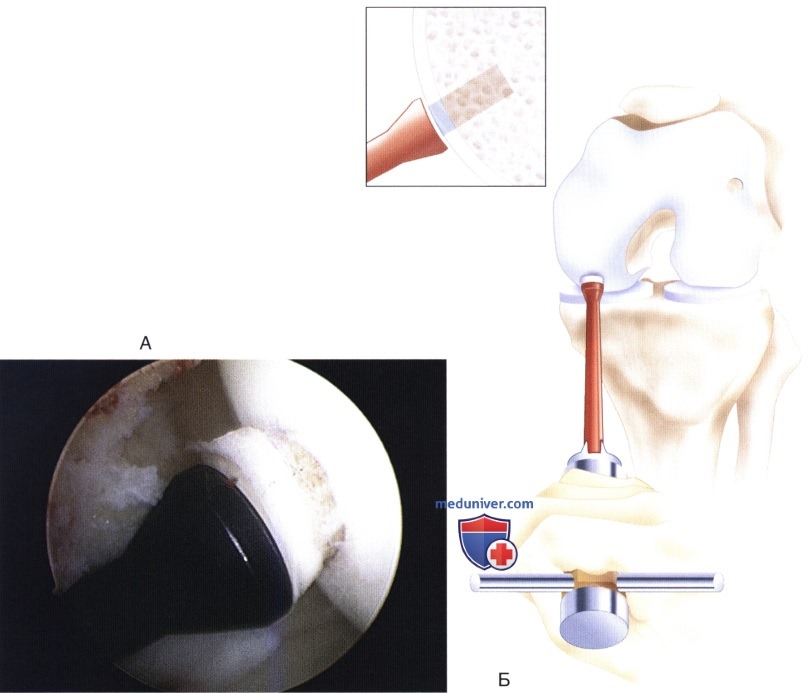 Доступ и техника остеохондральной аутотрансплантации коленного сустава