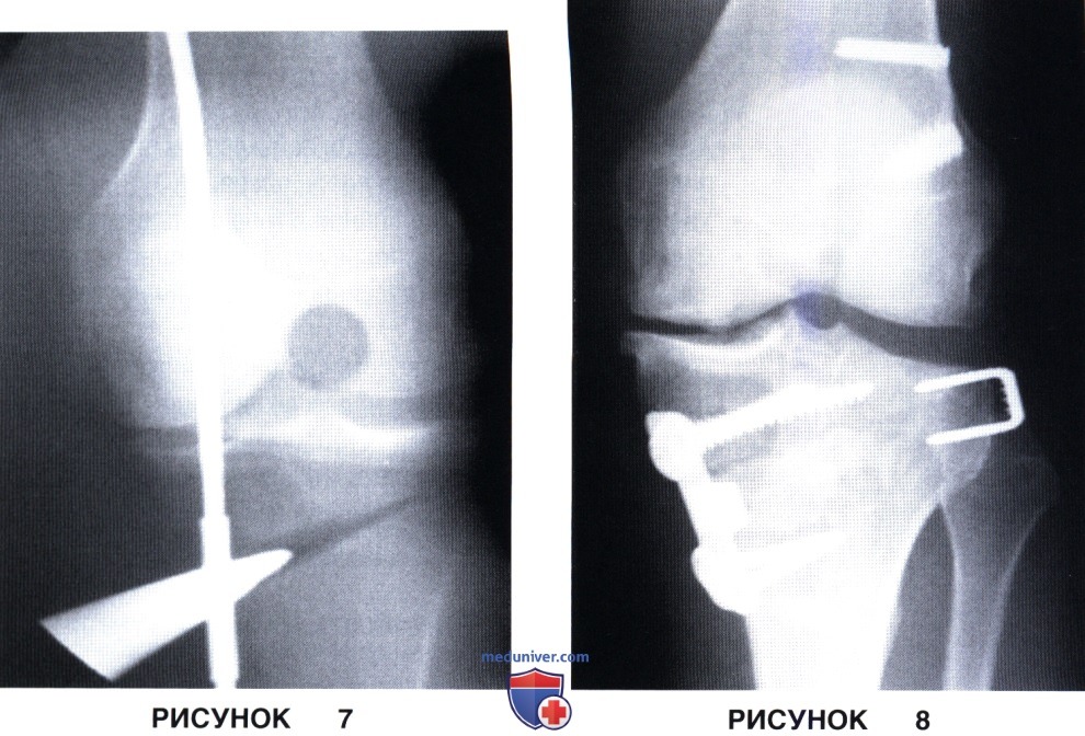 Доступ, техника открытой клиновидной высокой тибиальной остеотомии коленного сустава