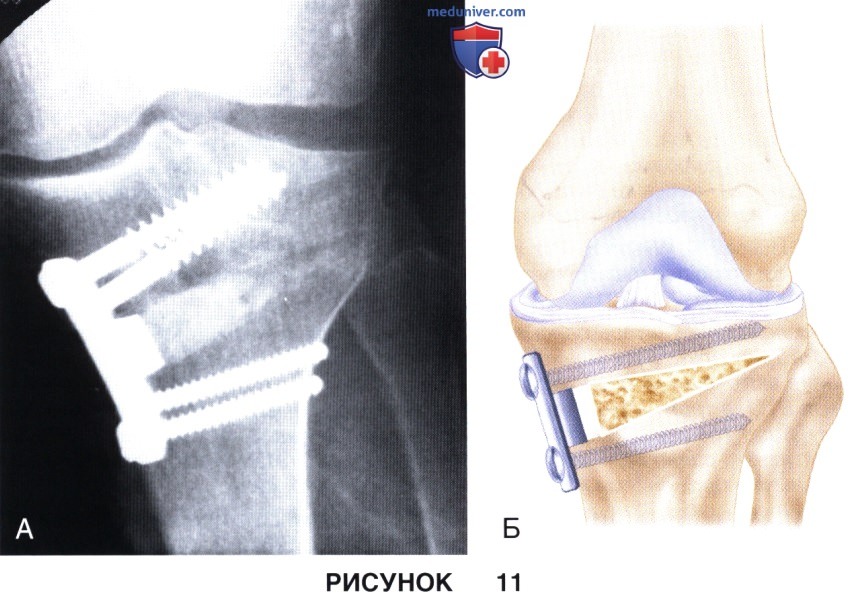 Доступ, техника открытой клиновидной высокой тибиальной остеотомии коленного сустава