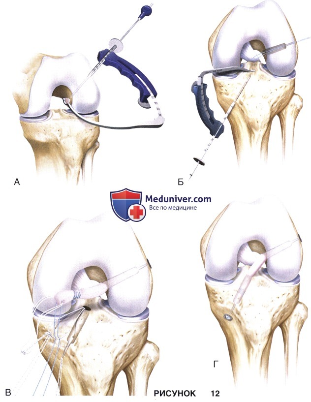 Доступ, техника первичной реконструкции передней крестообразной связки (ПКС) коленного сустава