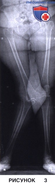 Показания, подготовка к тотальному эндопротезированию коленного сустава в условиях вальгусной деформации