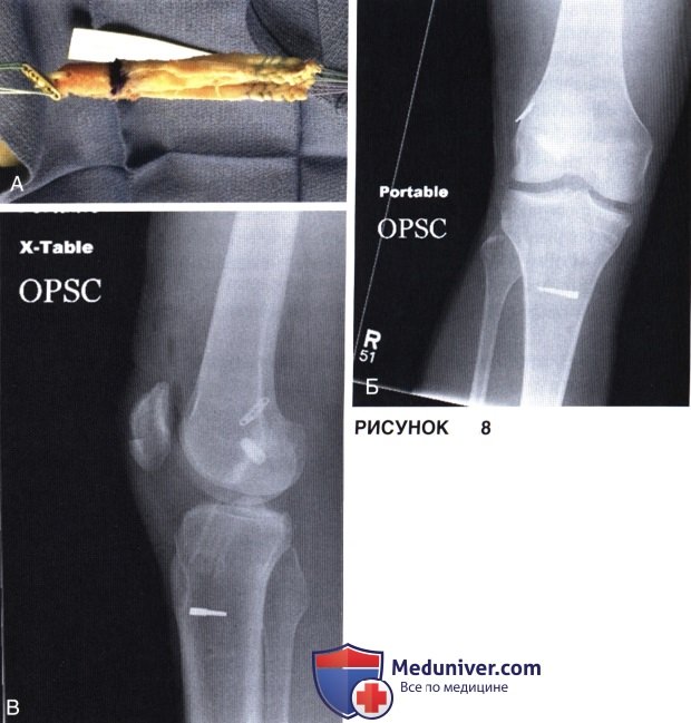Доступ, техника ревизионной реконструкции передней крестообразной связки (ПКС) коленного сустава