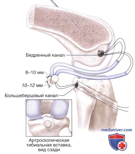 Доступ, техника восстановления и реконструкции задней крестообразной связки (ЗКС) коленного сустава
