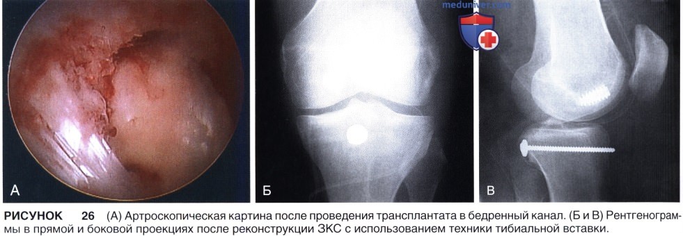 Доступ, техника восстановления и реконструкции задней крестообразной связки (ЗКС) коленного сустава