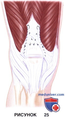 Доступ, техника восстановления сухожилия четырехглавой мышцы