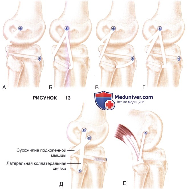 Доступ, техника восстановления и реконструкции задненаружного угла коленного сустава