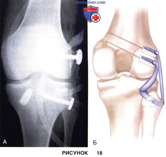 Доступ, техника восстановления и реконструкции задненаружного угла коленного сустава