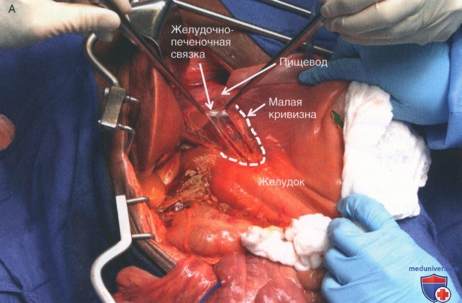 Техника, этапы операции при травме брюшной аорты и ее ветвей