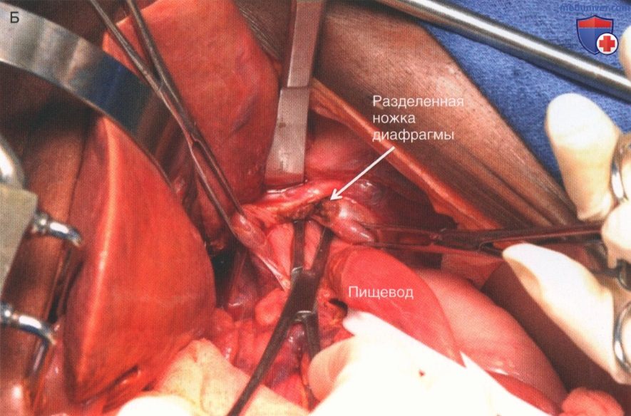 Техника, этапы операции при травме брюшной аорты и ее ветвей