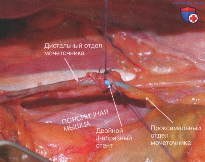 Техника, этапы операции при травме мочеточника