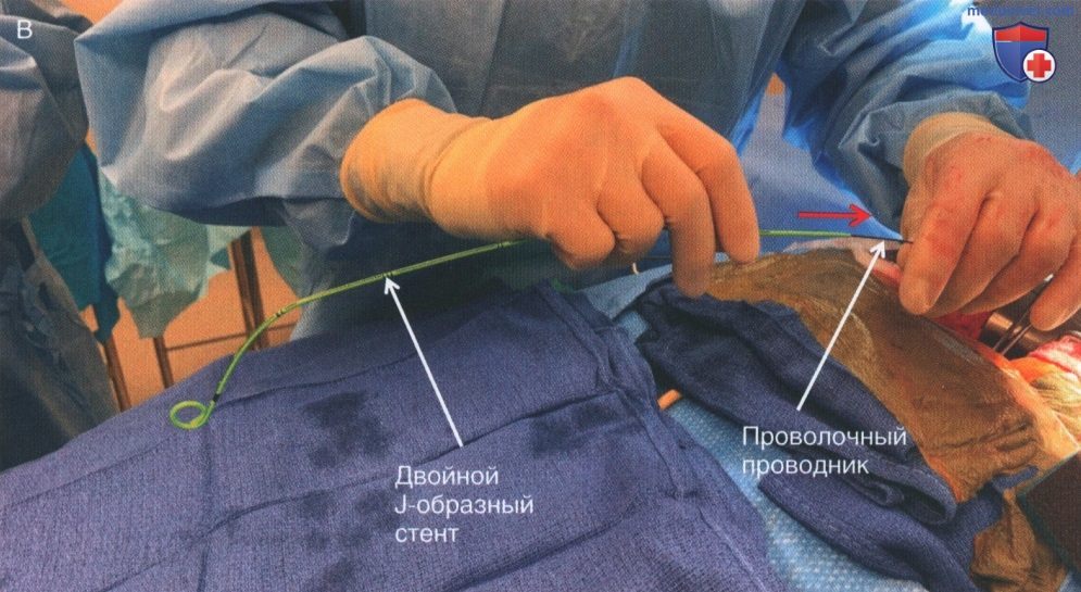 Техника, этапы операции при травме мочеточника