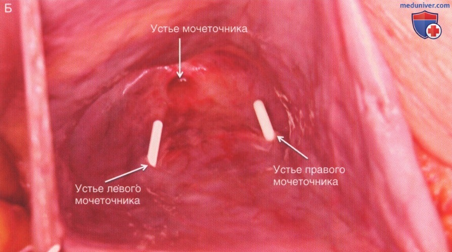 Техника, этапы операции при травме мочевого пузыря