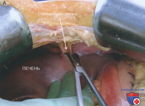 Техника, этапы операции при травме печени и желчевыводящих путей