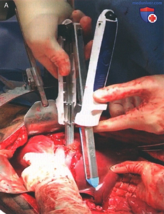 Техника, этапы операции при травме печени и желчевыводящих путей