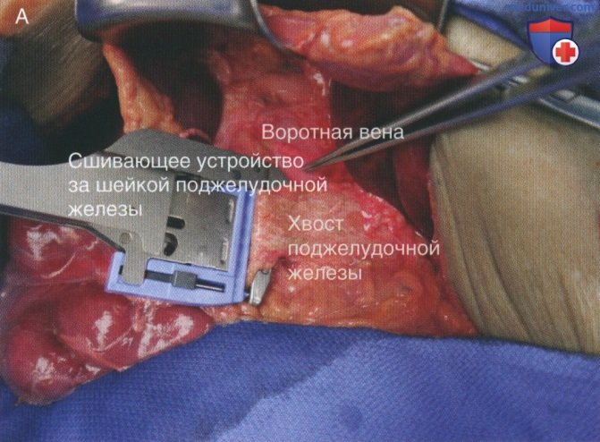 Техника, этапы операции при травме поджелудочной железы