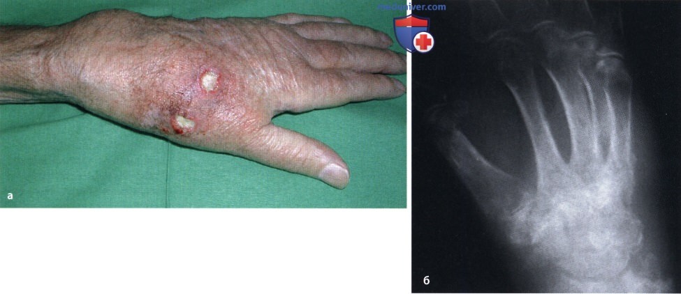 Туберкулезный остеомиелит и артрит