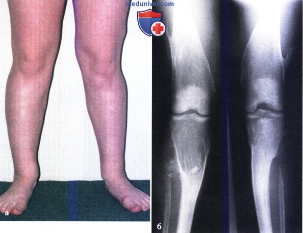 Вальгусная деформация коленных суставов (genu valgum)