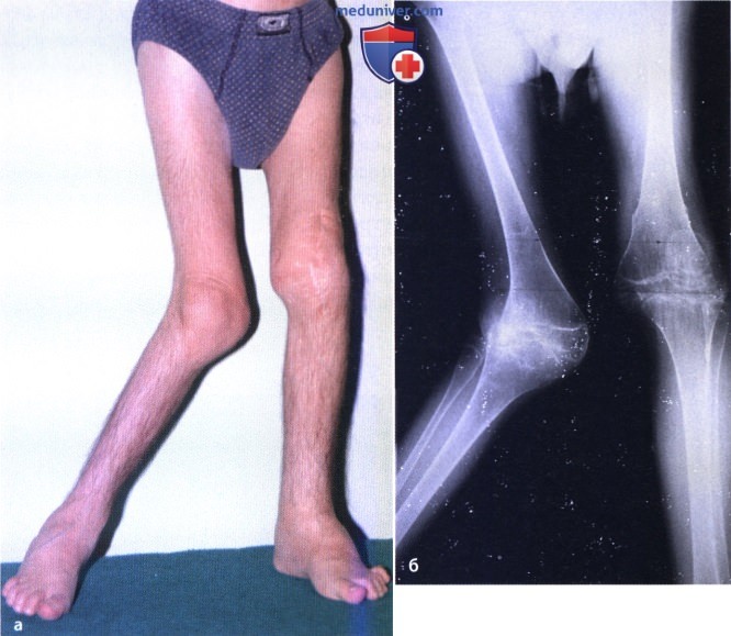 Вальгусная деформация коленных суставов (genu valgum)