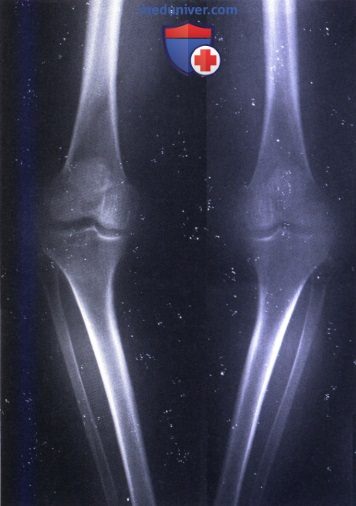 Варусная деформация коленного сустава (genu varum)