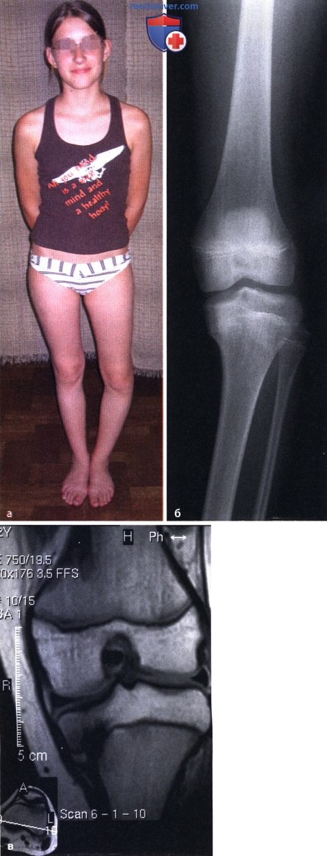 Варусная деформация коленного сустава (genu varum)