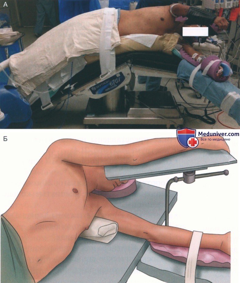 Техника, этапы операции при свернувшемся гемотораксе (ВАТС, видеоассистированная торакоскопическая операция, VATS)