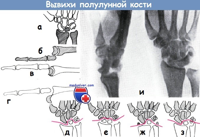 Перелом полулунной кости рентген thumbnail
