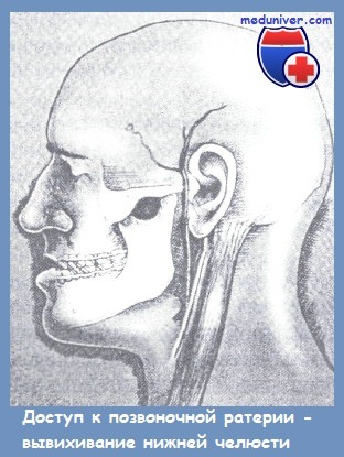 вывихивание нижней челюсти для доступа к позвоночной артерии