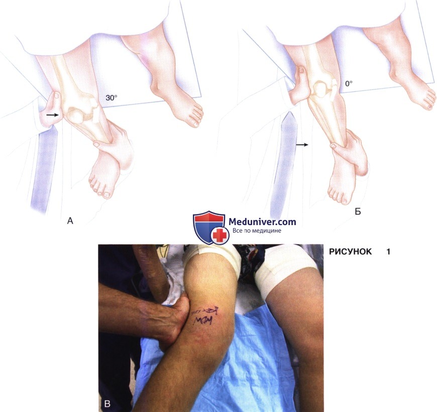 Показания, подготовка к восстановлению и реконструкции медиальной коллатеральной связки (МКС) коленного сустава