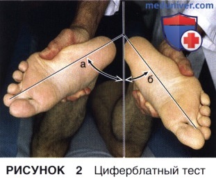 Показания, подготовка к восстановлению и реконструкции задней крестообразной связки (ЗКС) коленного сустава