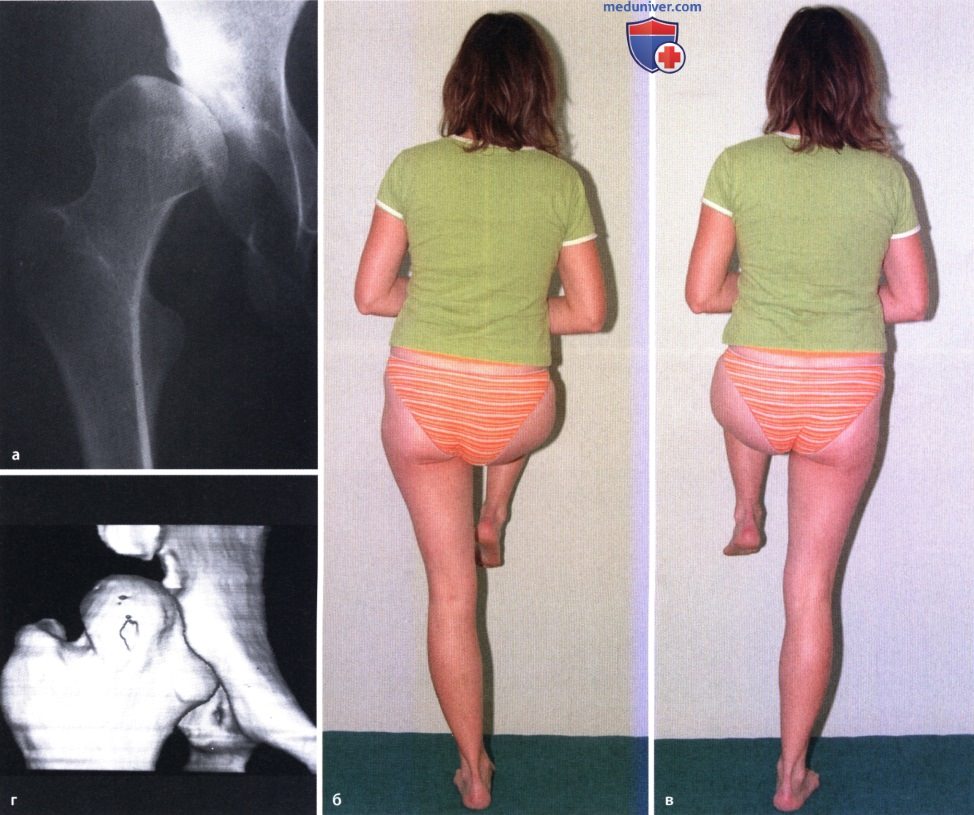 Вторичный остеоартроз тазобедренного сустава