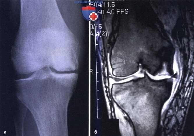 Вторичный остеоартроз коленного сустава