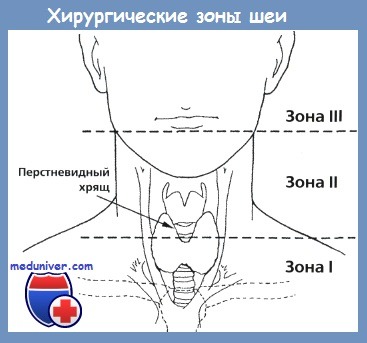 хирургические зоны шеи