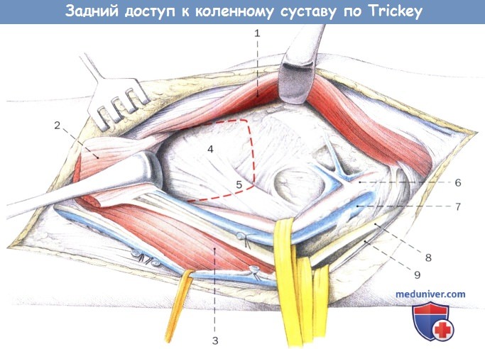 Техника заднего доступа к коленному суставу по Trickey