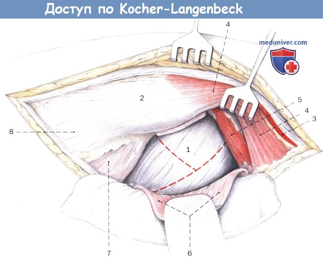 Задний доступ по Kocher-Langenbeck к тазобедренному суставу