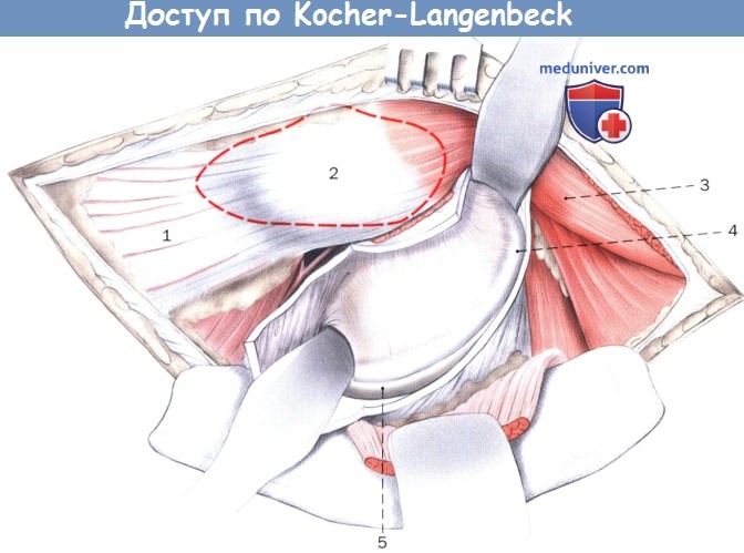 Задний доступ по Kocher-Langenbeck к тазобедренному суставу