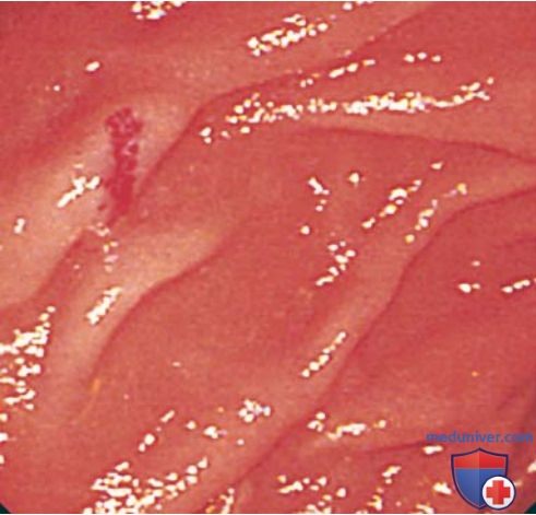 Желудочно-кишечное кровотечение (кровотечение их ЖКТ) - как симптом болезни желудочно-кишечного тракта