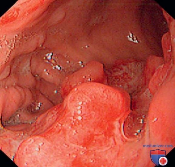 Опухоли желудка - кратко с точки зрения внутренних болезней