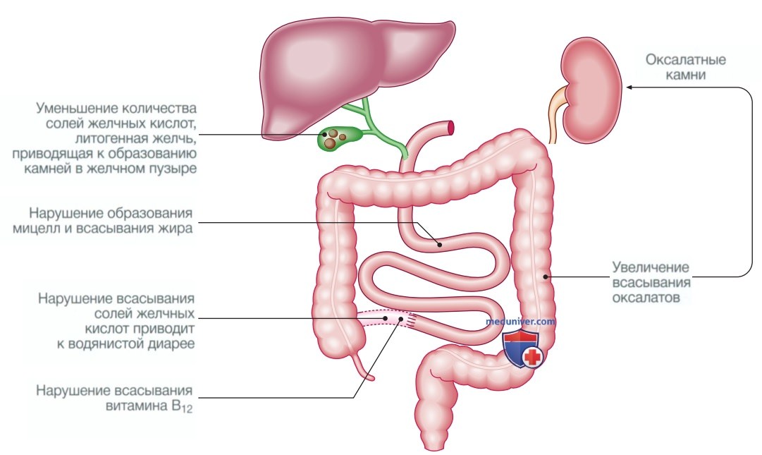Холегенная диарея - кратко с точки зрения внутренних болезней