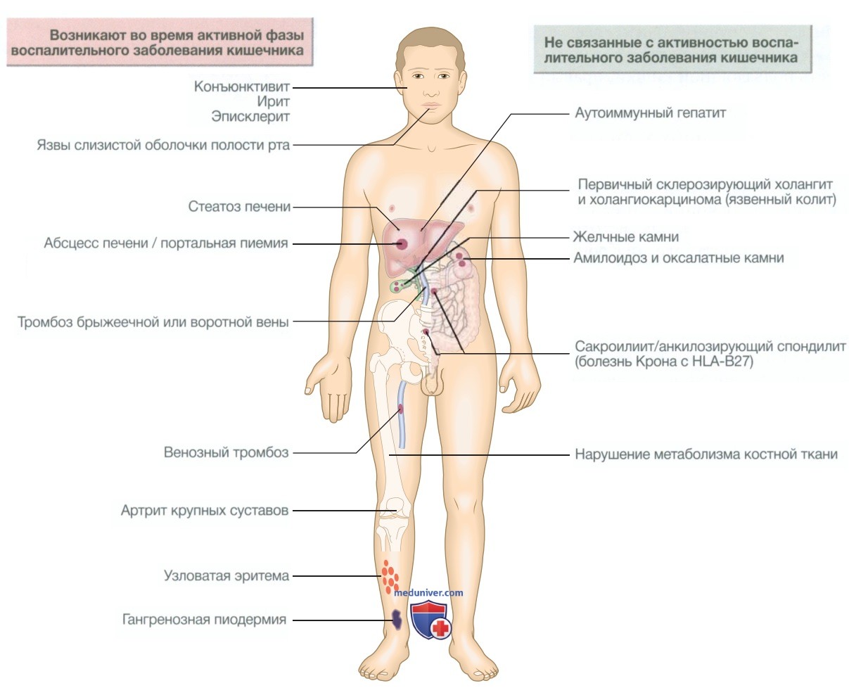 Воспалительные заболевания кишечника (язвенный колит, болезнь Крона)