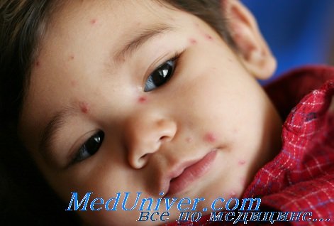 Гепатит при мононуклеозе у детей лечение thumbnail